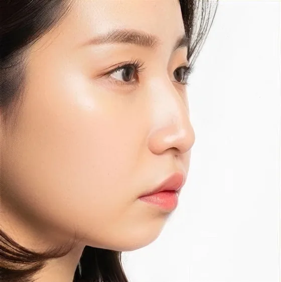 구강호흡형 얼굴